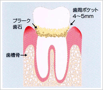 軽度の歯周病