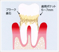 中度の歯周病