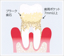 重度の歯周病