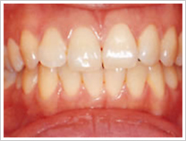 ホワイトニングの注意点